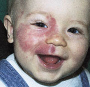 Beckwith-Wiedemann syndrome Beckwith-Wiedemann_syndrome (6).jpg